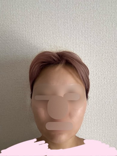 after photo: インモード