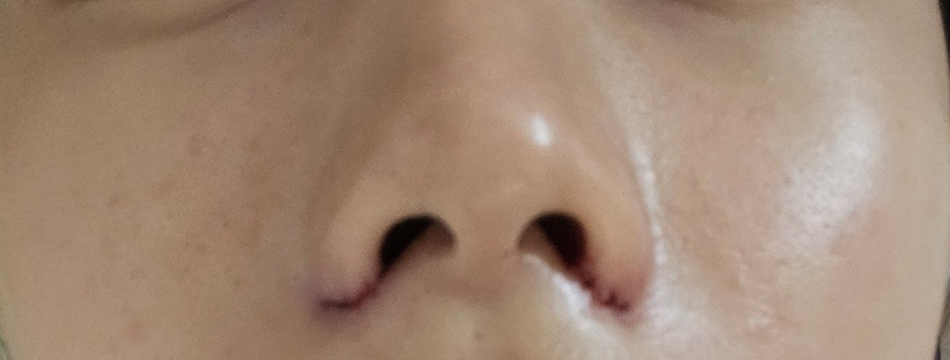 after photo: 콧볼축소