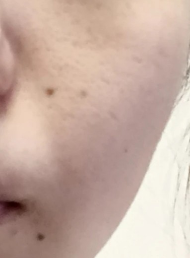 after photo: IPL(光/フォト治療), 診断・検査