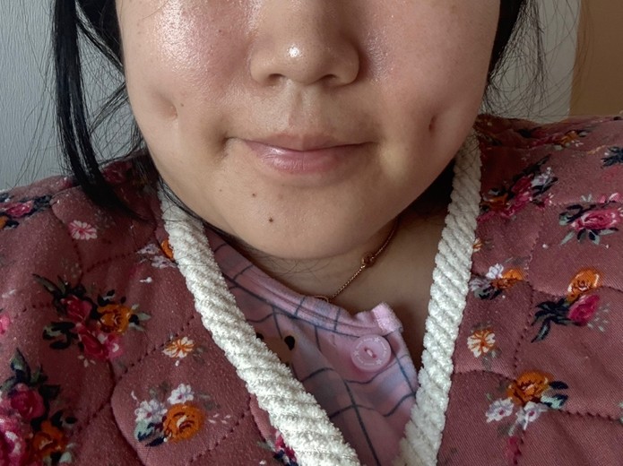 after photo: 보조개성형