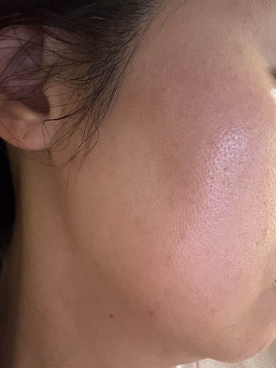 after photo: IPL(光/フォト治療)