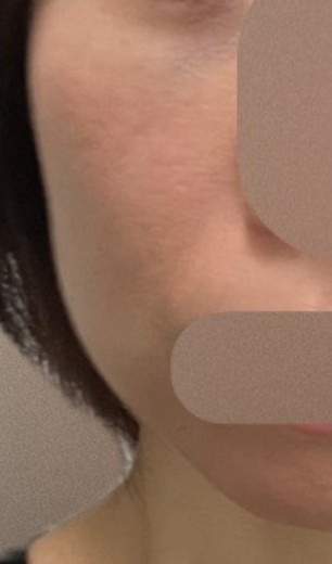 after photo: ボルニューマ