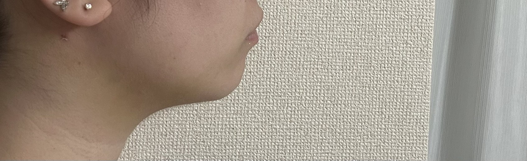 after photo: 脂肪吸引(顎下)