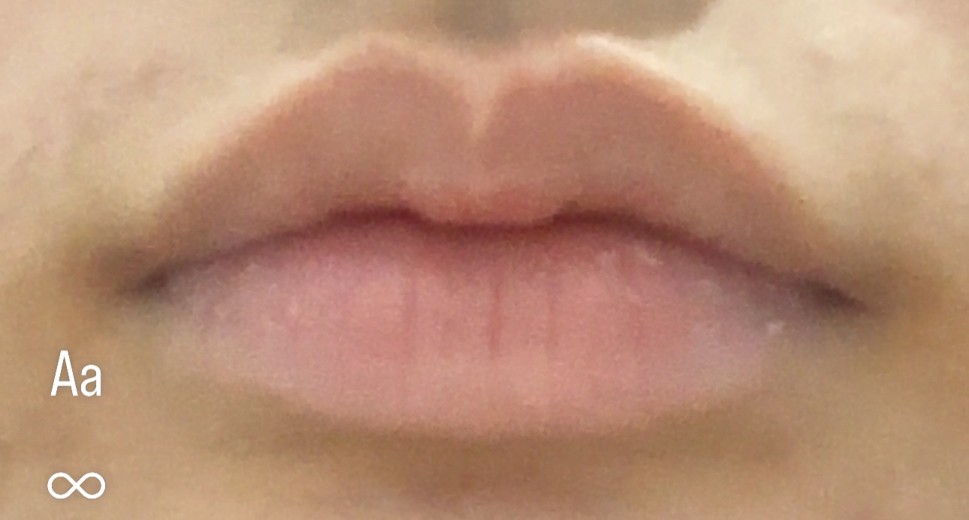 before photo: 입꼬리필러, 입술필러