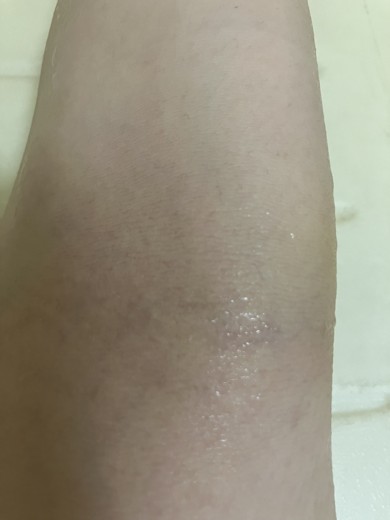 after photo: ビタミン注射・点滴