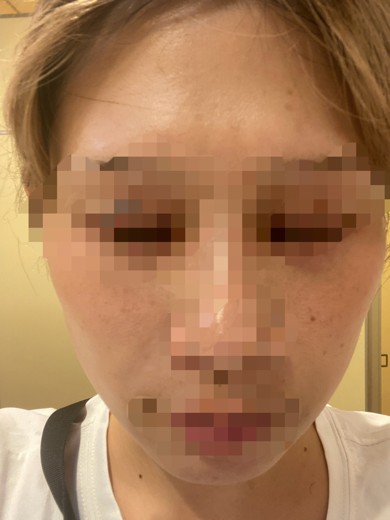 after photo: IPL(光/フォト治療), ピーリング