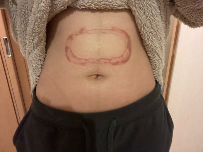 after photo: 脂肪冷却(腹部)