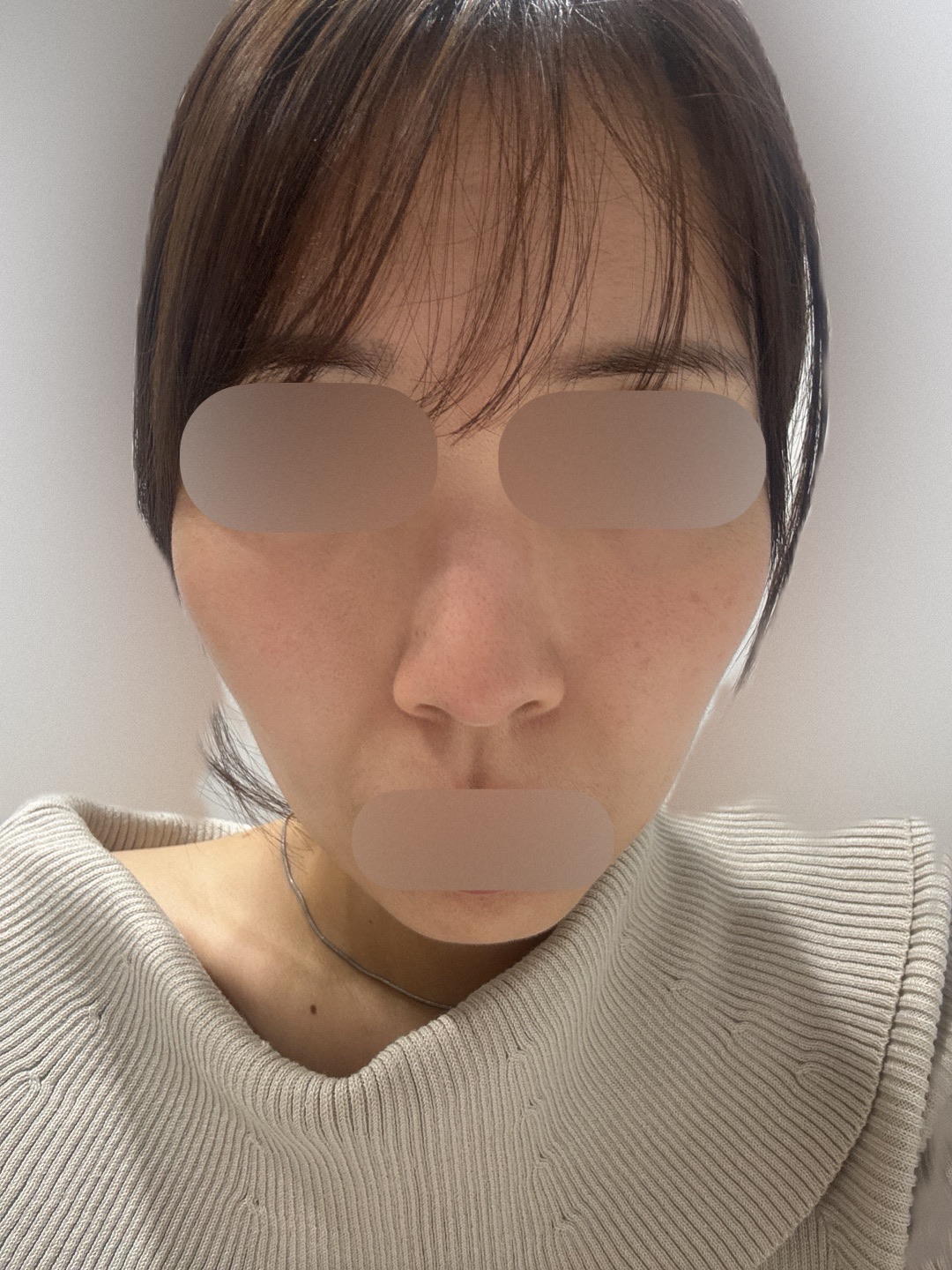 ピーリング　エレクトロポレーション マッサージピール、エレクトロポレーション、ケミカルピーリングのご