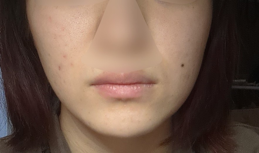 before photo: IPL(光/フォト治療), イオン導入