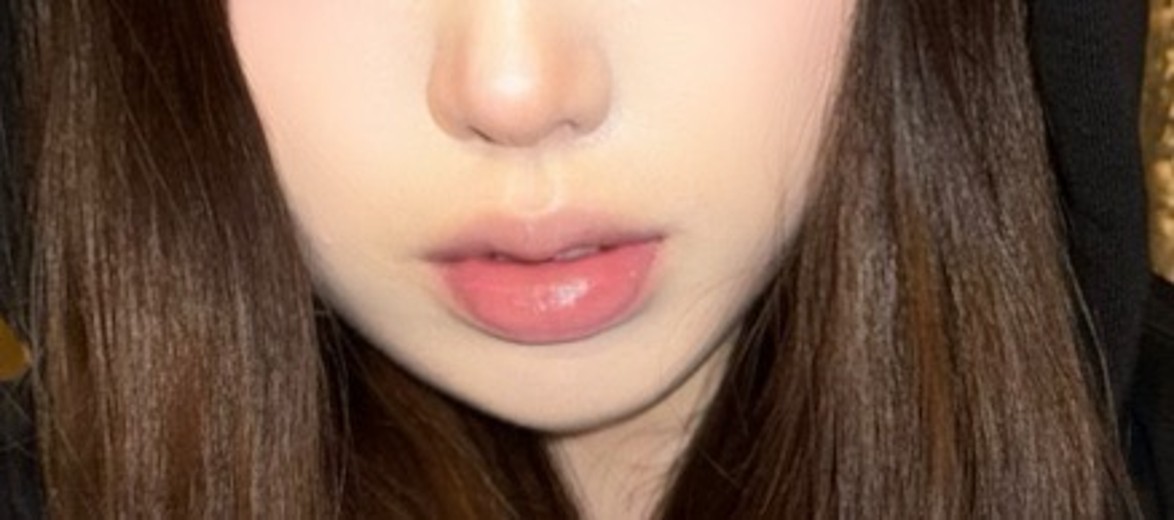 before photo: 보조개성형