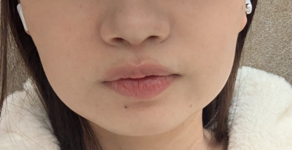 after photo: 口角ボトックス
