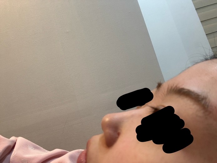 before photo: 콧대(보형물), 코끝(자가연골)