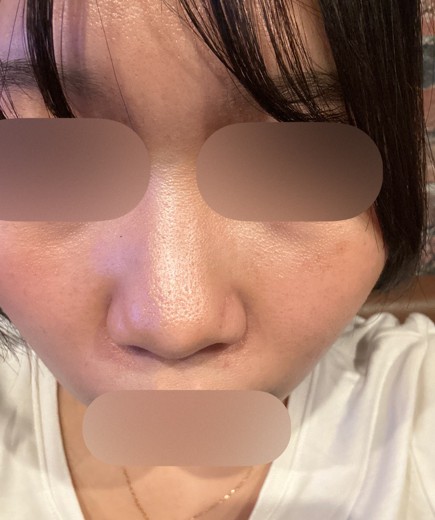 after photo: ハイドラフェイシャル