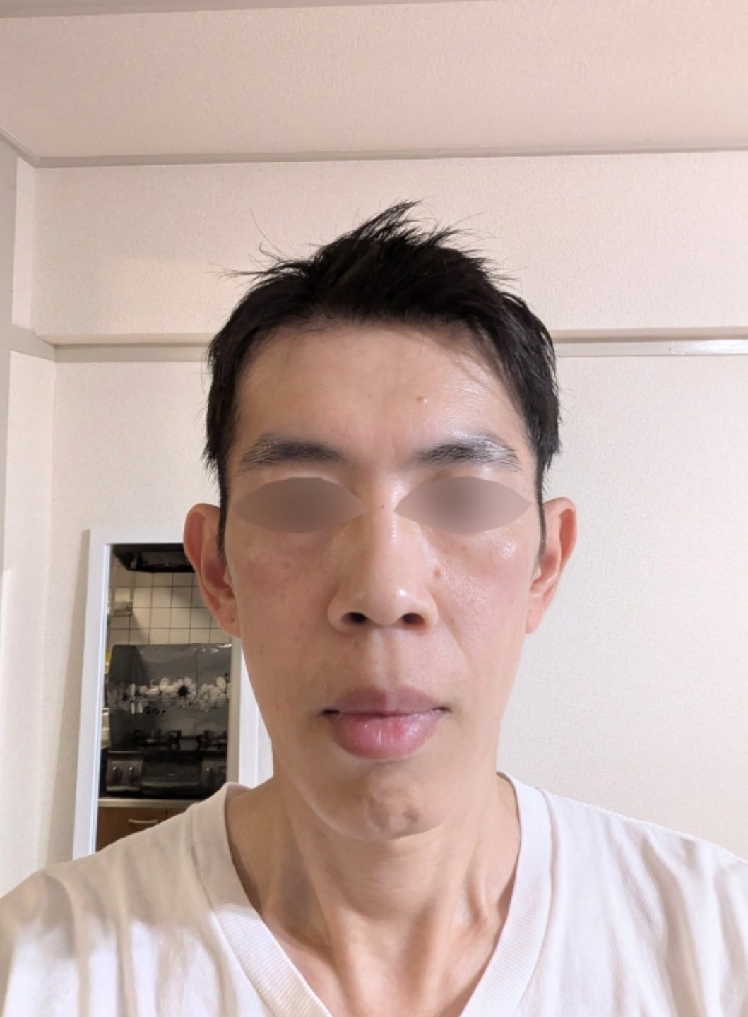 全顔シミ取り放題＋美顔レーザートーニング【11月30日迄にご予約頂いた