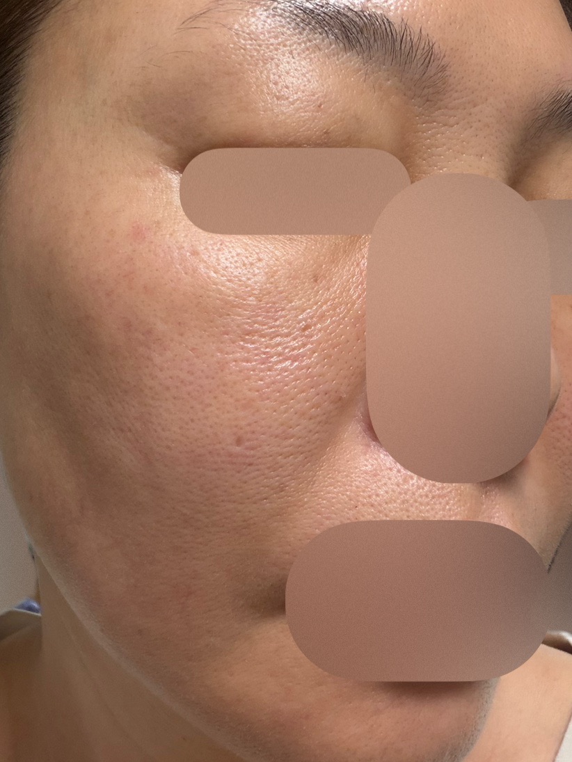 参考写真 何度でも可】全顔ケミカルピーリング＋顔脱毛セット | ZX-CLINIC