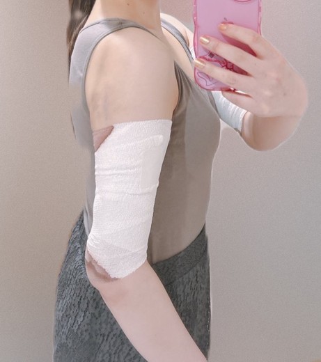 after photo: 脂肪吸引(腕)