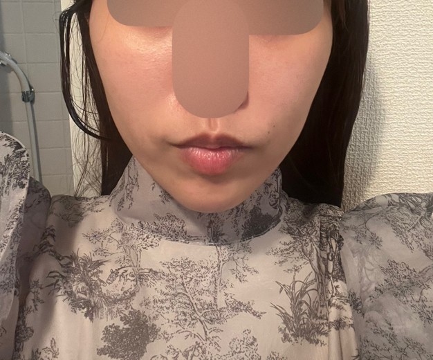 after photo: 糸リフト