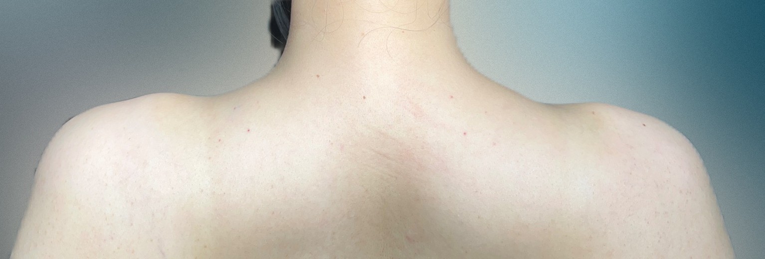 after photo: 脇ボトックス, エラボトックス, 肩ボトックス(僧帽筋)