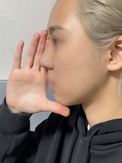 after photo: 콧대(보형물), 코끝(자가연골), 복코교정(수술)