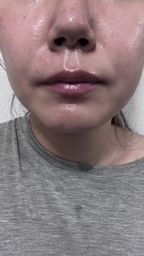 after photo: 診断・検査, ジュベルック(Juvelook)