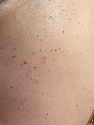 after photo: IPL(光/フォト治療), 診断・検査