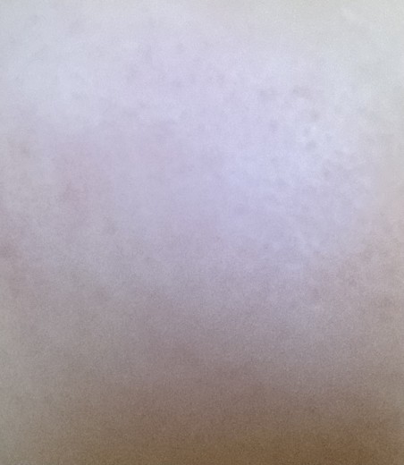 after photo: レーザートーニング, トラネキサム酸