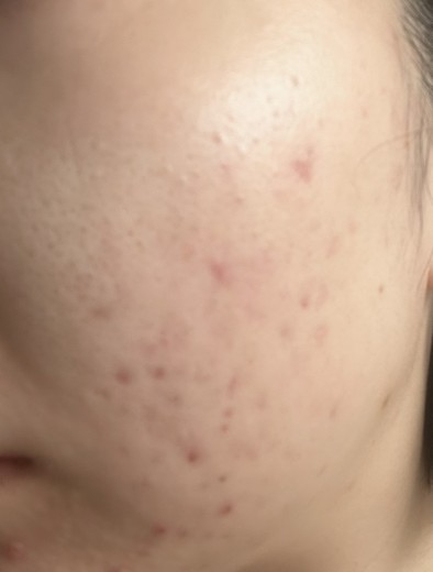 after photo: IPL(光/フォト治療), 診断・検査