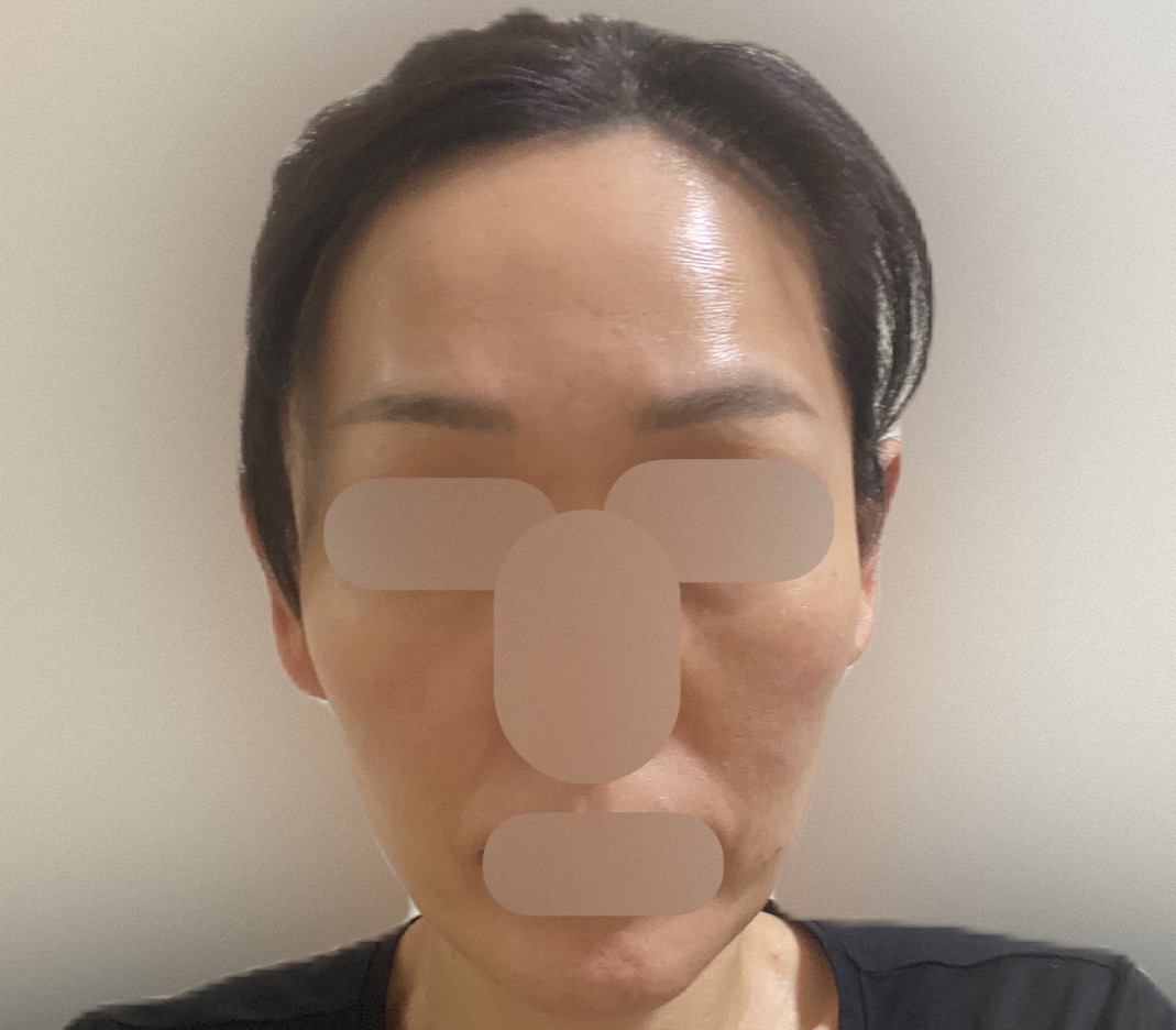 何度でも可】美顔レーザートーニング｜シミ・肝斑・毛穴・くすみ改善