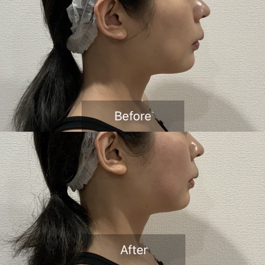 after photo: チタニウムリフト, ミラノリピール