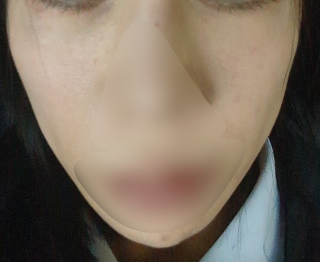after photo: IPL(光/フォト治療)