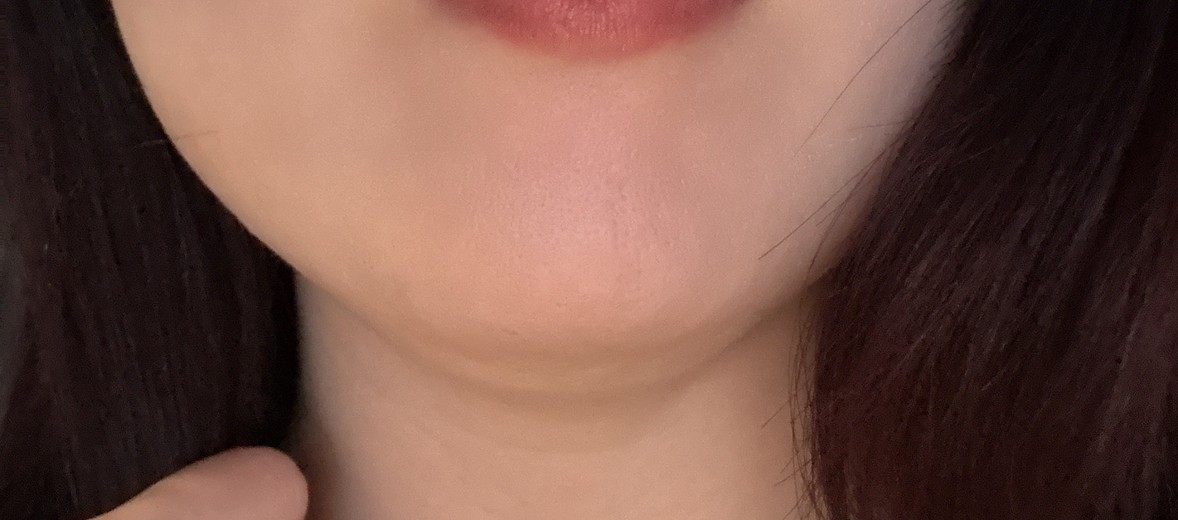 after photo: 脂肪溶解注射(顔)