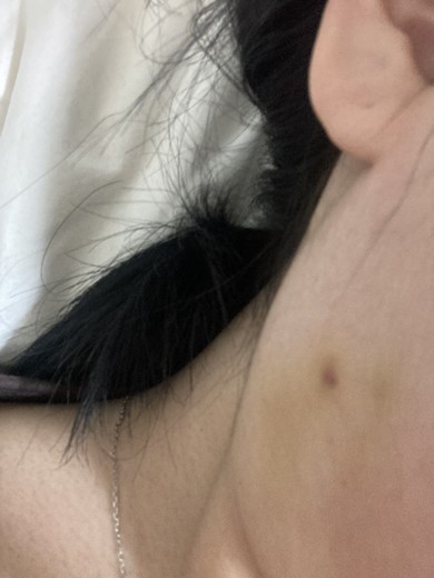 before photo: 윤곽주사, 사각턱보톡스