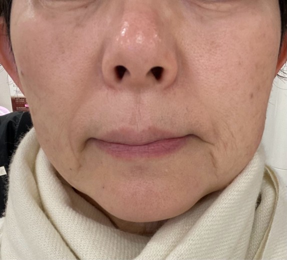 before photo: ヒーライト