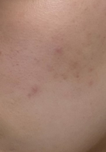 before photo: ピーリング, トラネキサム酸
