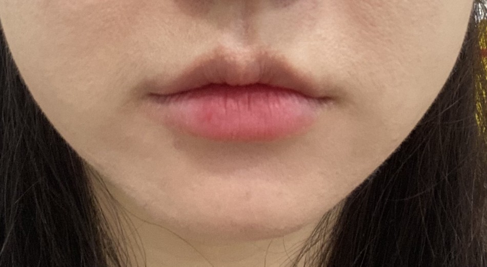 before photo: 윤곽주사, 얼굴지방분해주사