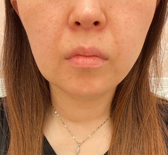 after photo: 脂肪溶解注射(腕), 脂肪溶解注射(顔)