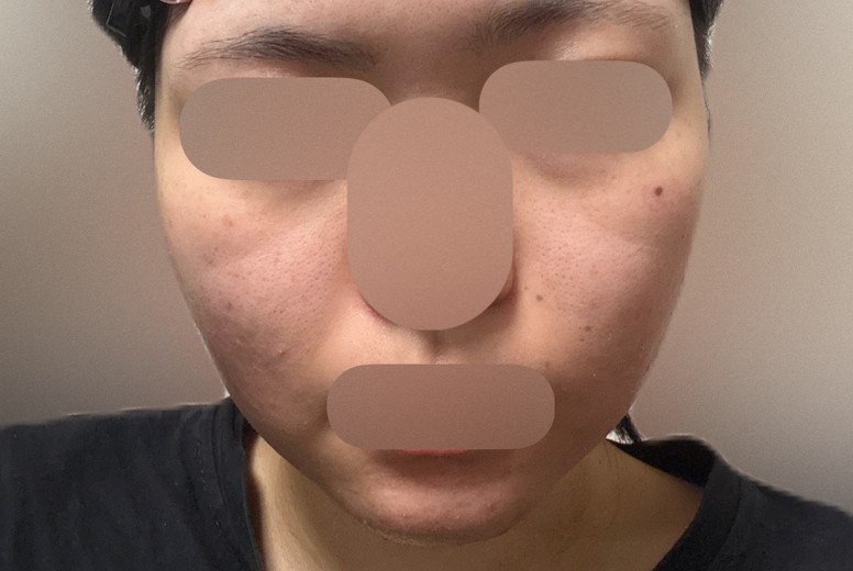 before photo: IPL(光/フォト治療)