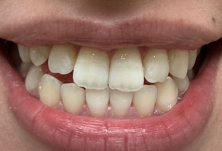 after photo: ホワイトニング