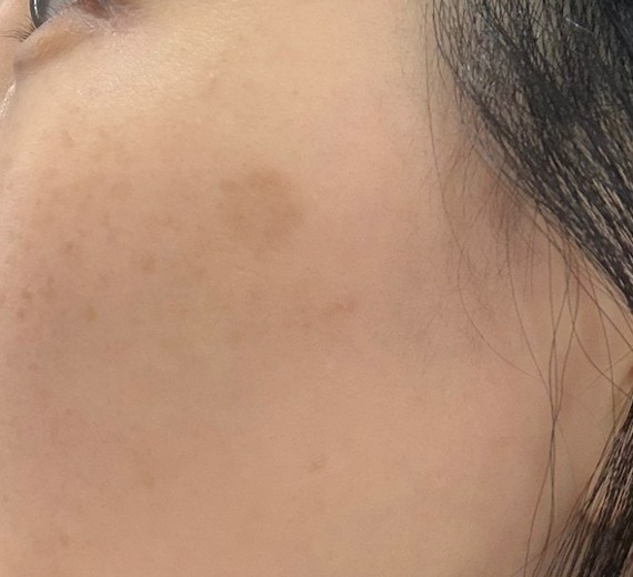 after photo: 리팟레이저