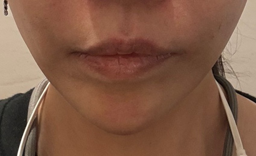 before photo: 脂肪溶解注射(顔)
