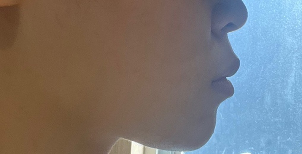 after photo: 턱필러