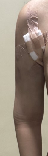 after photo: 복부지방흡입