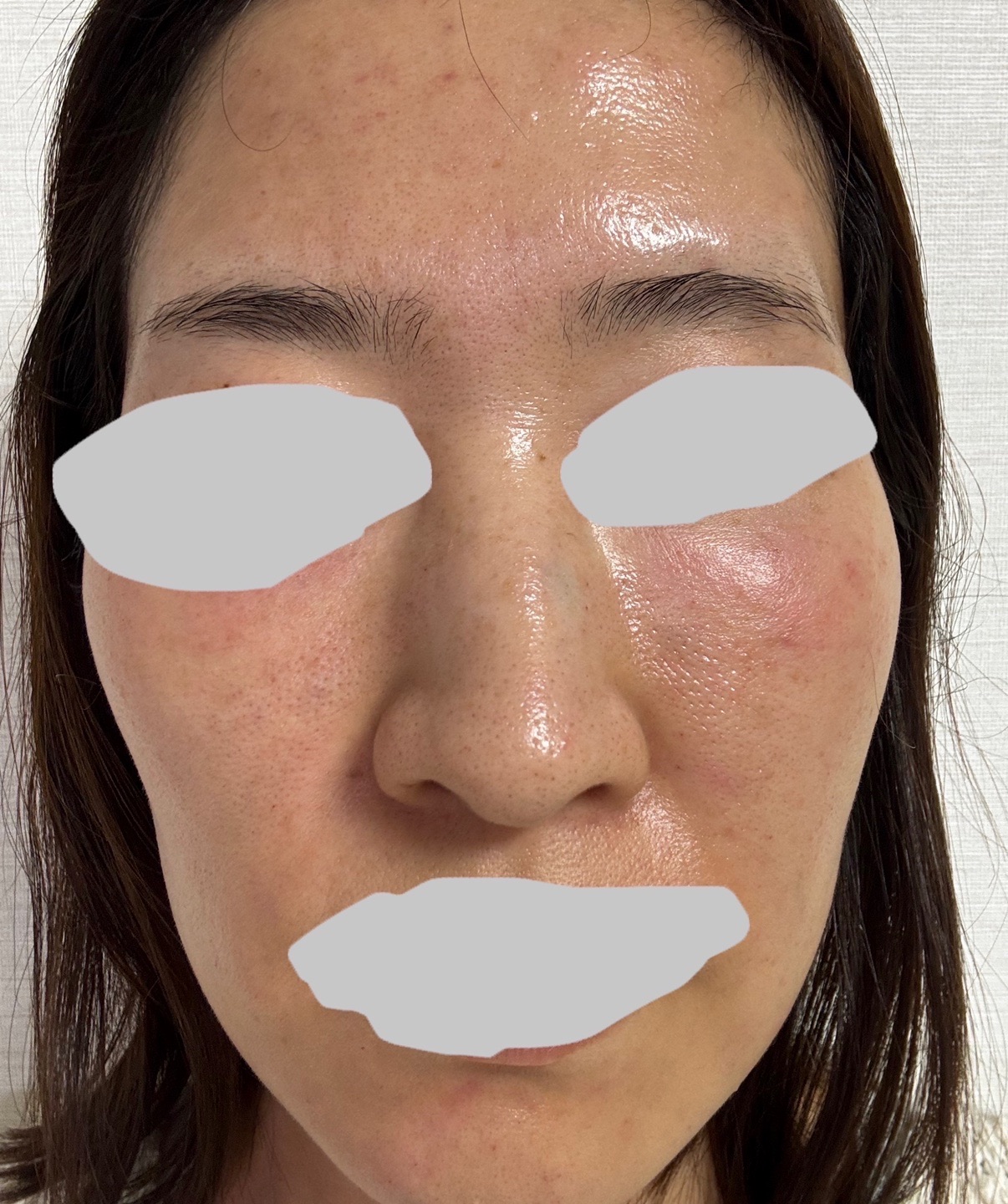 水光注射サイトケア532（全顔） 1回【再来OK】 | ライズワン美容皮膚科