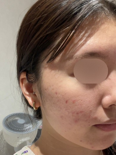 before photo: ピーリング, ララピール(LHAピーリング)