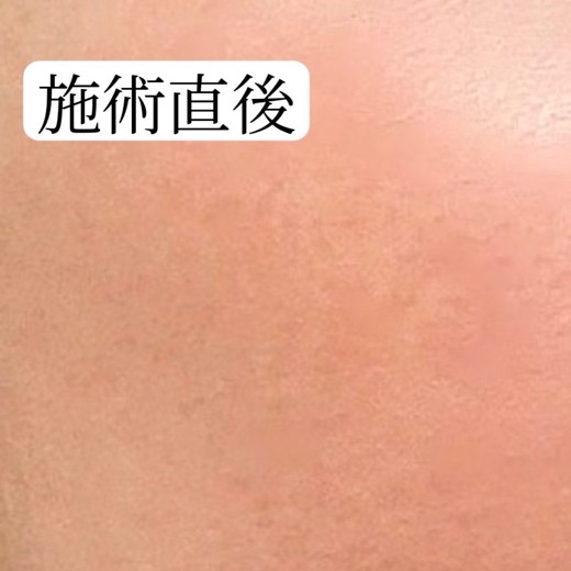 after photo: エレクトロポレーション