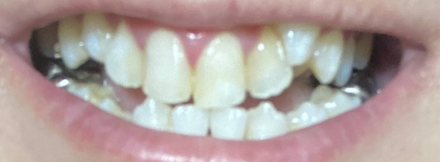 after photo: ホワイトニング