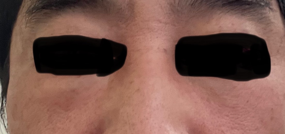 after photo: サーモン注射