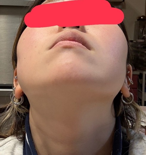 before photo: 糸リフト, 脂肪吸引(顎下), 脂肪吸引(顔), 脂肪吸引(頬)