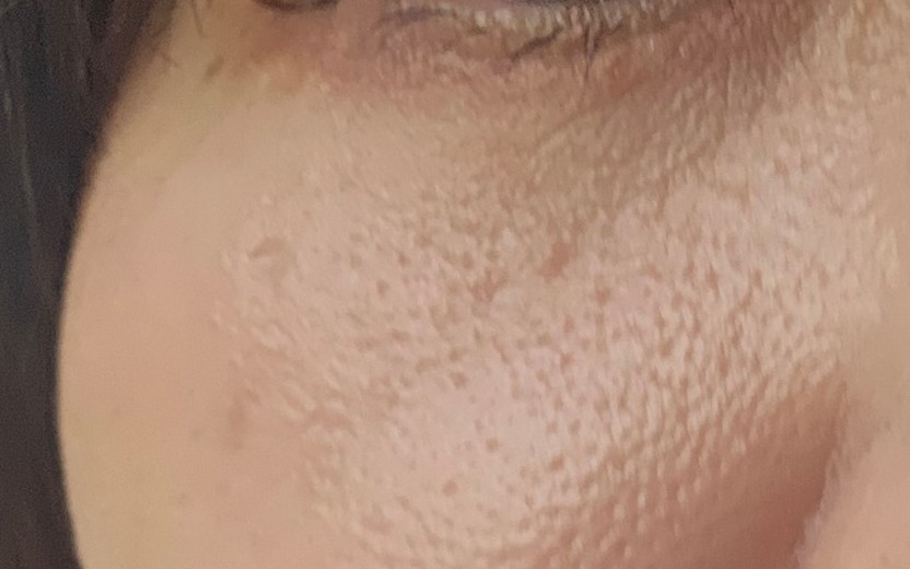 after photo: 리쥬란아이