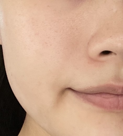 before photo: IPL(光/フォト治療), ルメッカ